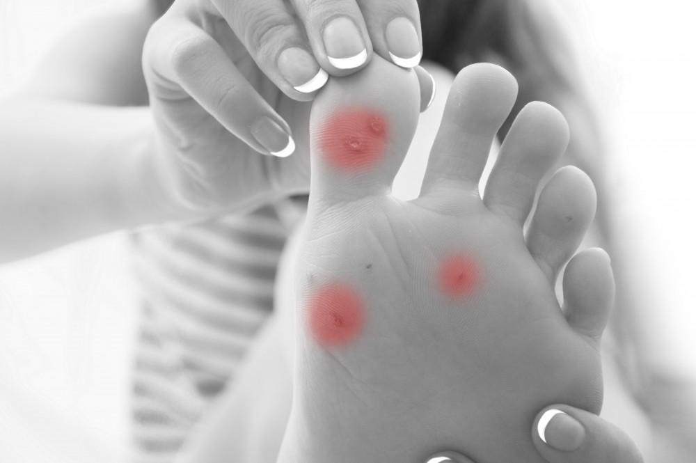 Different types of Foot Corns