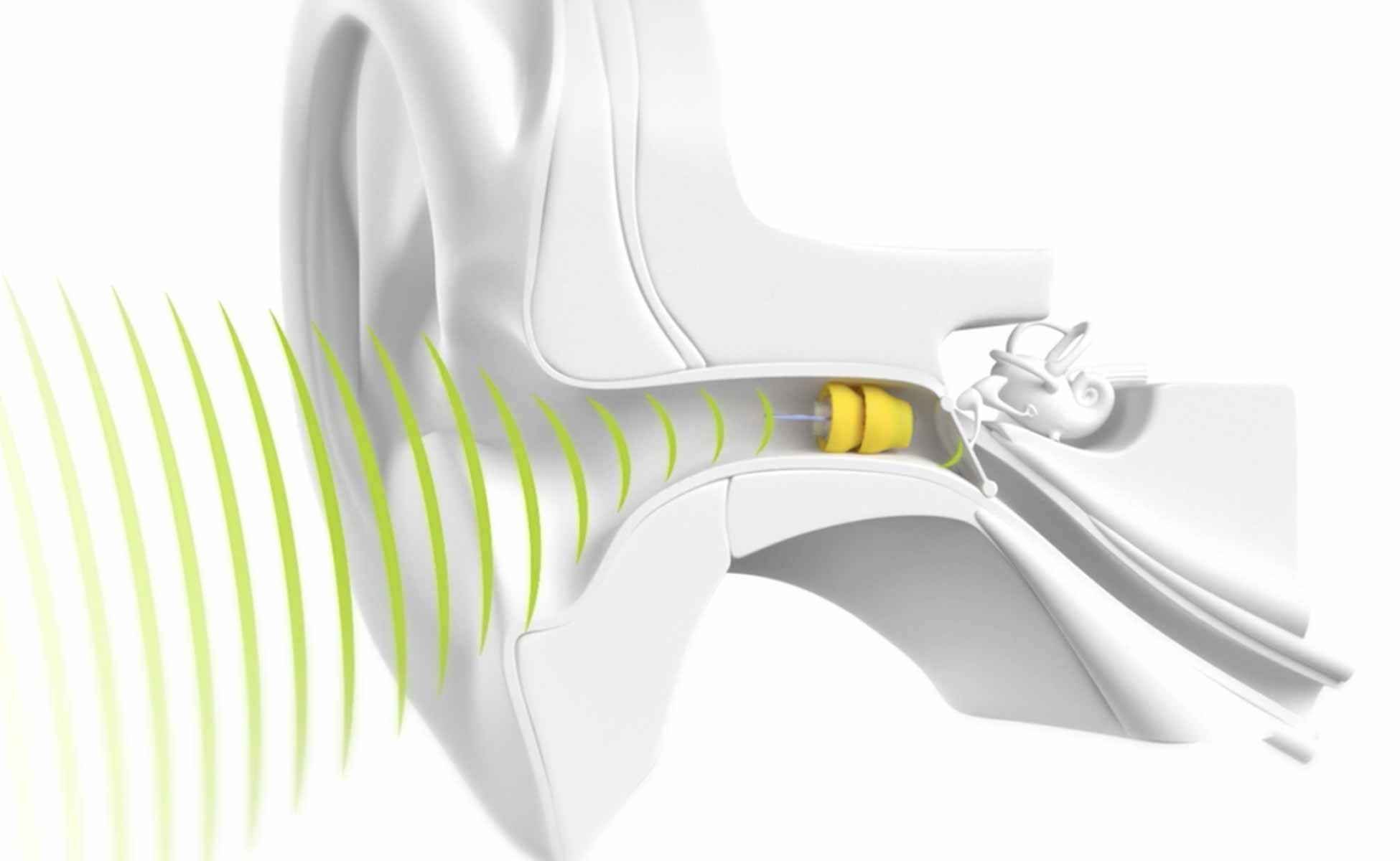 Exploring Discrete Hearing Aid Options